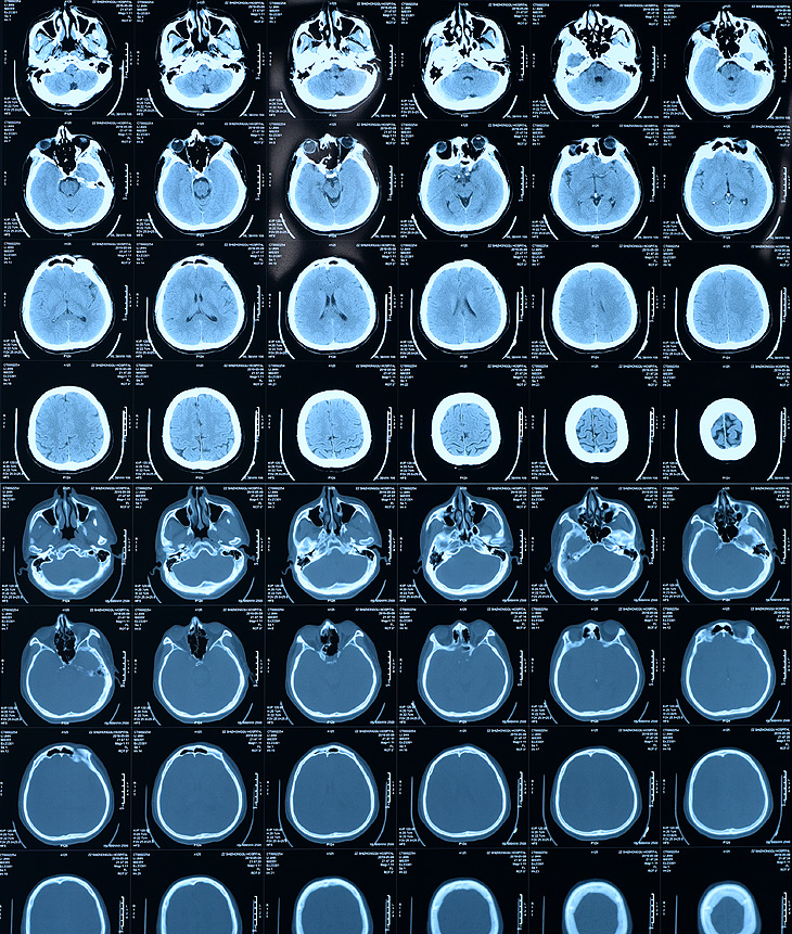 RM-HL Medical Thermal Dry Image Film